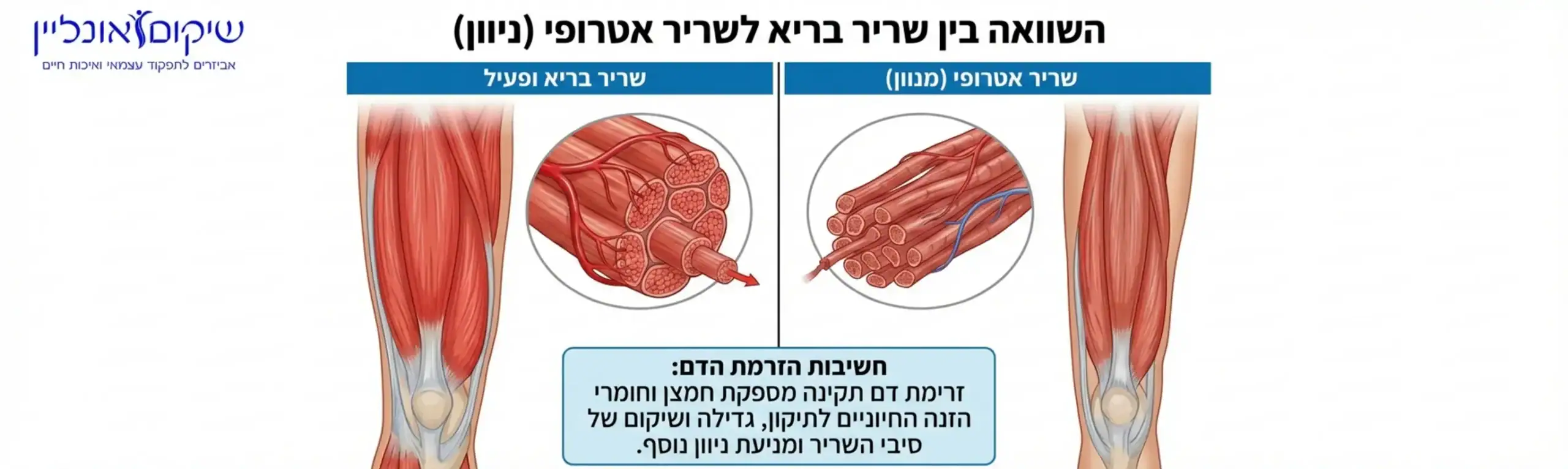 אינפוגרפיקה המציגה השוואה ויזואלית של שריר בריא מול שריר שעבר אטרופיה, עם דגש על סיבי השריר ברגל, וכיתוב שמסביר על חשיבות הזרמת הדם לשיקום