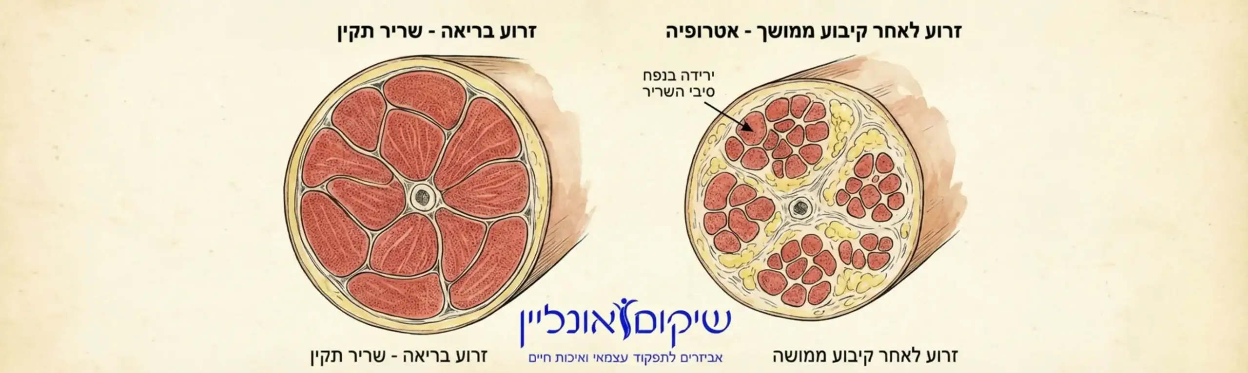 איור רפואי המשווה בין חתך שריר של זרוע בריאה לבין חתך שריר של זרוע לאחר קיבוע ממושך המראה ירידה בנפח סיבי השריר